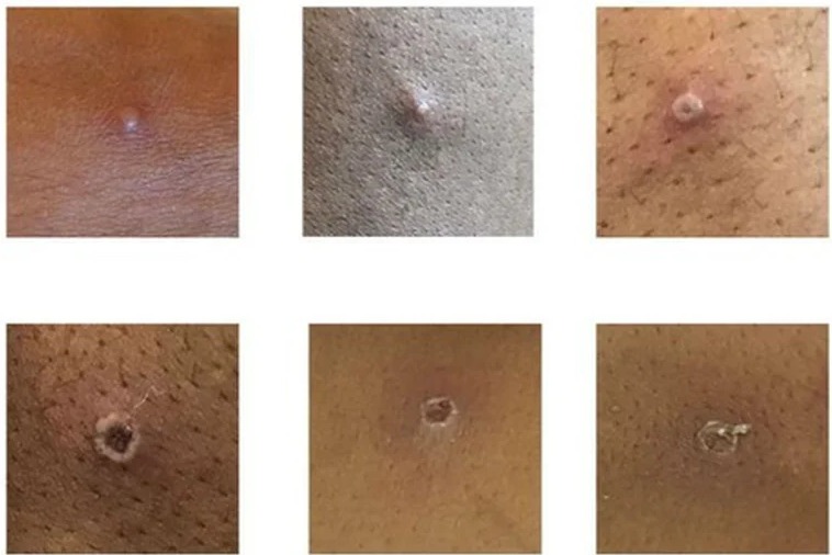  Detectan el sexto caso de viruela del mono en Colombia